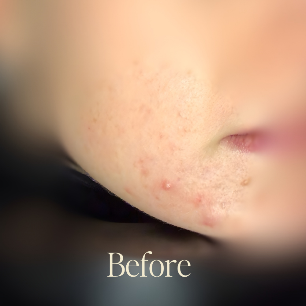 Genaura Acne Before and After 1