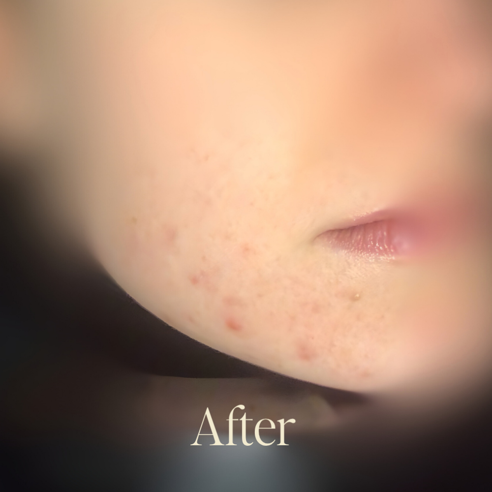 Genaura Acne Before and After 2