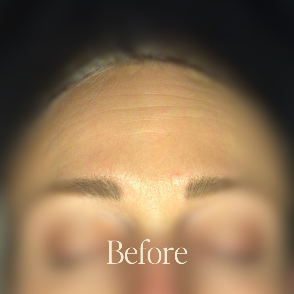 Genaura Fine Lines Before and After 1