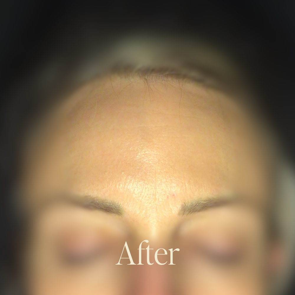 Genaura Fine Lines Before and After 2