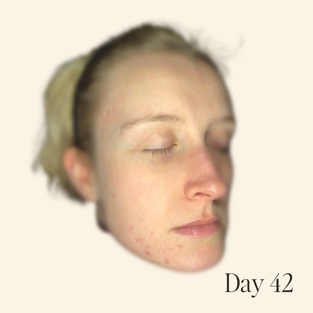 Genaura levagen+ Results Reduction of breakouts & irritation Shrink 2